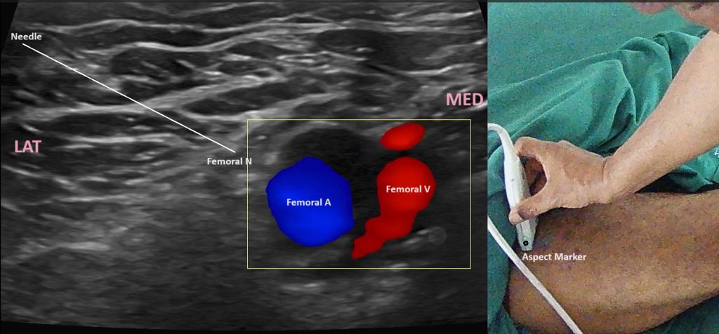 usg-guided Femoral Nerve Block usg-guided Femoral Nerve Block